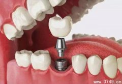 牙齿缺失不及时修复会引起一系列的问题 建议及