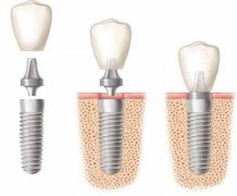 种植牙的治疗步骤 应该如何维护种植牙？