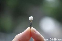种牙价究竟怎么算？ 一颗牙一万“跟买房似的”