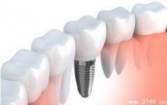 种植牙安全性对比 避免牙肉和牙床骨萎缩
